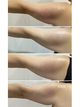 セラス(CERAS)/フォースカッター　二の腕30分