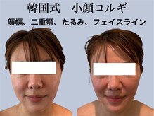 ジェイオー(J.O)/小顔矯正コルギ/リンパコルギ