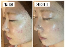 ハオン(HAON)/ハーブピーリング/ニキビ/毛穴