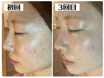 ハオン(HAON)/ハーブピーリング/ニキビ/毛穴