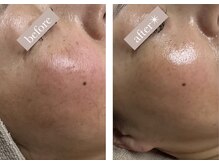 エバーグリーン(Evergreen)/ハーブピーリング×ヒト幹細胞