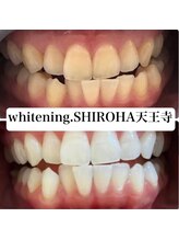 シロハ(SHIROHA)/セルフホワイトニング/天王寺