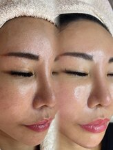 アトリーチェ ベレッツァ(ATTRICE Bellezza)/光フェイシャル×水素毛穴洗浄