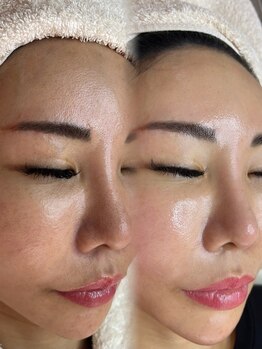 アトリーチェ ベレッツァ(ATTRICE Bellezza)/光フェイシャル×水素毛穴洗浄