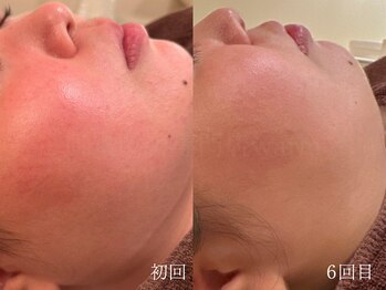 ウォーム(warm)/乾燥/敏感肌/赤み/フェイシャル