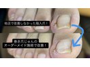 陥入爪もオーダーメイド施術