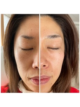 サロンピュア 所沢店/たるみ改善!