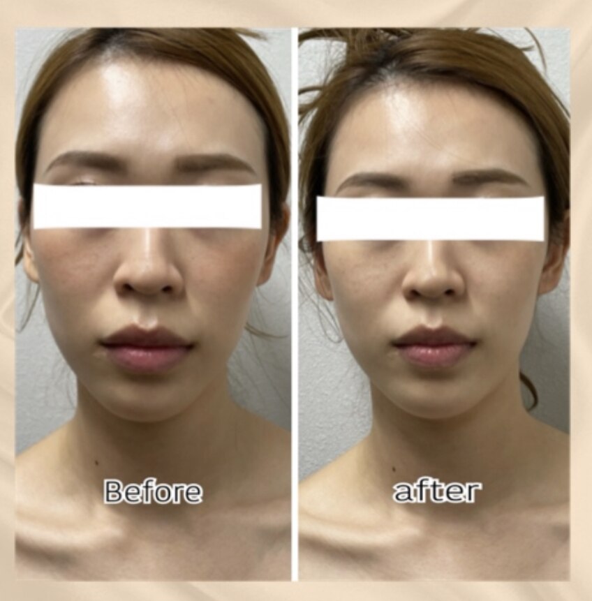 最終処分！超音波美顔器♡速攻小顔効果 最終処分！超音波美顔器♡速攻小顔効果