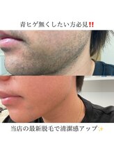 ラグズ(Ruxuce)/ヒゲ脱毛/美肌ケア