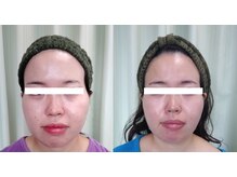 ソフィーム/エンビロンfasial月に一度