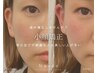 【予約No.1♪小顔矯正+高周波☆】究極の小顔スペシャルセット♪27500→9900