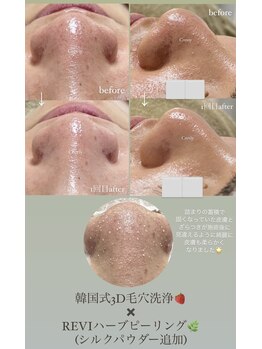 クレヴィー(Creviy)/韓国式3D毛穴洗浄×ハーブ(1回)