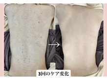 スキンハピネス(skinhappiness)/背中ハーブピーリング