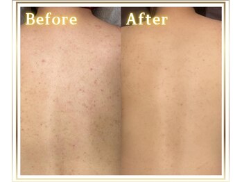 ジュエルリング(Jewel Ring)/背中ニキビピーリング