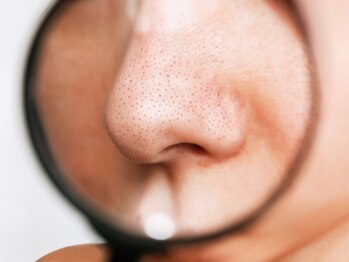 メンズガーデン(men's Garden)の写真/毛穴/黒ずみ/ニキビケア≪毛穴洗浄ハイドラフェイシャル¥5500顔全体/毛穴洗浄+毛穴収縮コース¥8800≫