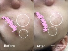 ラウレア(LAULEA)/シミケアBefore/after(3ヶ月)