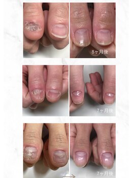 ティアラネイル 宇都宮/深爪矯正