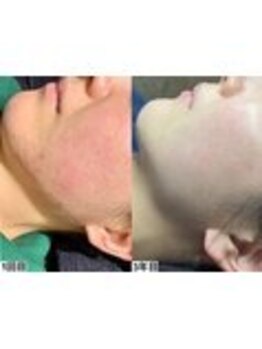 アンドミー 鹿児島中山(&me)/ハーブピーリング【肌質改善】