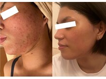 ルポ 那覇(repos)/肌トラブル特化美容鍼（100分）