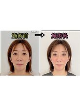 シャルム(Charme)/小顔矯正施術１回
