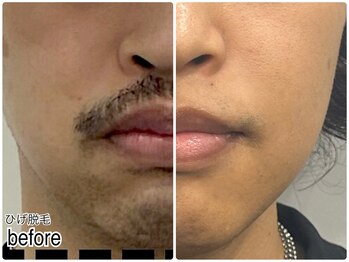 エンチャント(ENCHANT)/ひげ脱毛