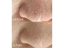 洗顔サロン 池袋(SENGAN)/気になる黒ずみ毛穴も解消