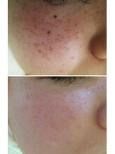 サロンドエステケイワイ(de KY)/フェイシャル☆濃いシミ改善