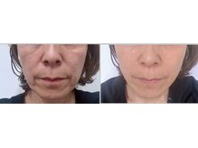 ジュエルビューティー(Jewel Beauty)/WINBACK！とWiQo水光ピーリング