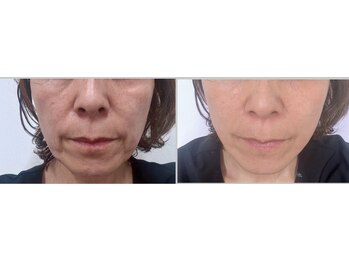 ジュエルビューティー(Jewel Beauty)/WINBACK！とWiQo水光ピーリング