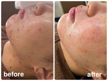 デューン 蕨店(Dune)/ハーブピーリング