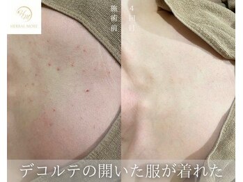 ハーブのほし/デコルテのあいた服を着れた!