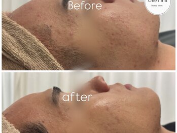 アンリミット 恵比寿店(Unelimit)/ハーブピーリングBefore→after