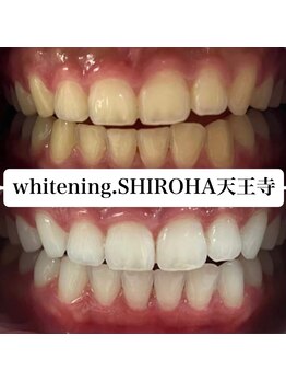 シロハ(SHIROHA)/セルフホワイトニング/天王寺