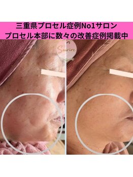 スリール(sourire)/60代女性・施術３回☆加工ナシ！