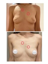美人バスト 浦和店/【バストアップ★育乳】症例