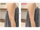 リフト 静岡(Lift)の写真/【1回でも変化を実感】二の腕・ハミ肉を集中ケア◎写真映えする華奢見えラインへ
小顔/二の腕/たるみ