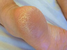 トータルビューティーサロン キララ(KIRARA)/かかと角質ケア