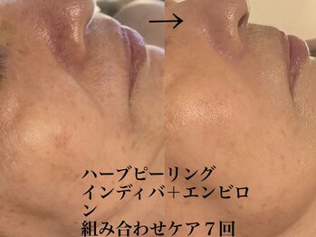 シュリー(Sriii)/ハーブピーリング&エンビロン