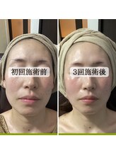 ル ボヌール/シミケア　3回目