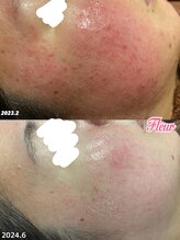 フルール(Fleur)/◆肌赤み/赤ら顔/毛穴◆