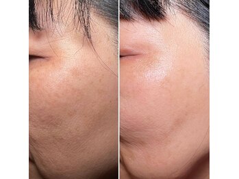 アプローズ(APPLAUSE)/シミケア 水光肌フェイシャル