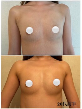 リール 新宿店(RIRE)/20代前半 バストアップ症例