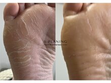 ロンディネ(Rondine)/足裏角質ケア足裏角質ケア38