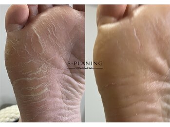 ロンディネ(Rondine)/足裏角質ケア足裏角質ケア38