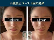 キュープ 表参道店(Qpu)/たった4回でここまで変わります