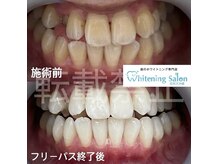 ホワイトニングサロン 福岡天神店/ホワイトニング