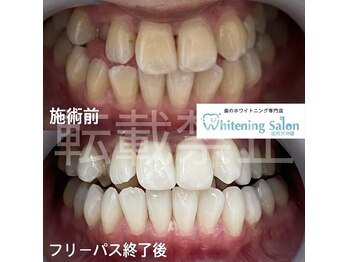 ホワイトニングサロン 福岡天神店/ホワイトニング