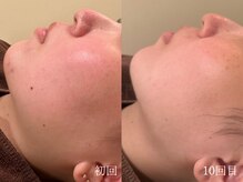 ウォーム(warm)/乾燥/敏感肌/赤み/フェイシャル