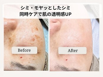 ル ボヌールの写真/ダウンタイムなし！シミケア特化型の最新光美容機器でシミなし、同時に複数の肌悩みを解消♪ボヤシミも◎