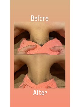 ラ メール(La mer)/うなじ脱毛